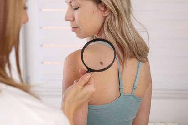 What Are Traditional Skin Lesion Removal Methods Billingshurst?
