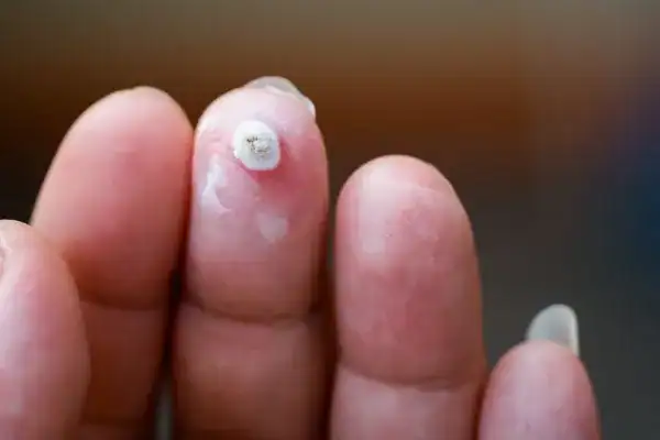 Image of white wart before cryopen treatment Billingshurst