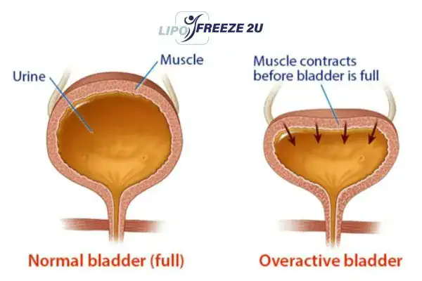 diagram of overactive bladder treatment Billingshurst