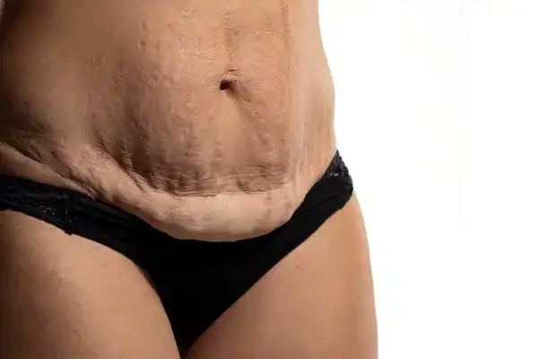 loose skin after weight loss injections Billingshurst