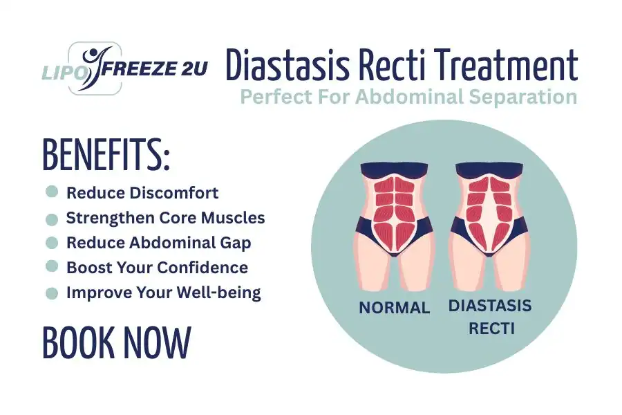 Benefits of body toning treatment Billingshurst for Diastasis recti