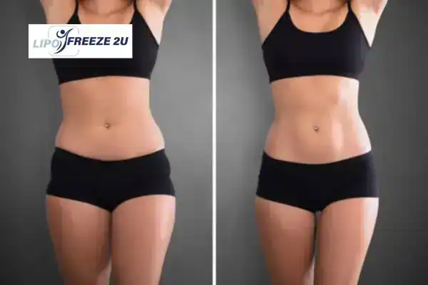 How Can LIPO FREEZE 2U Support Your Post-Pregnancy Body Recovery Billingshurst?