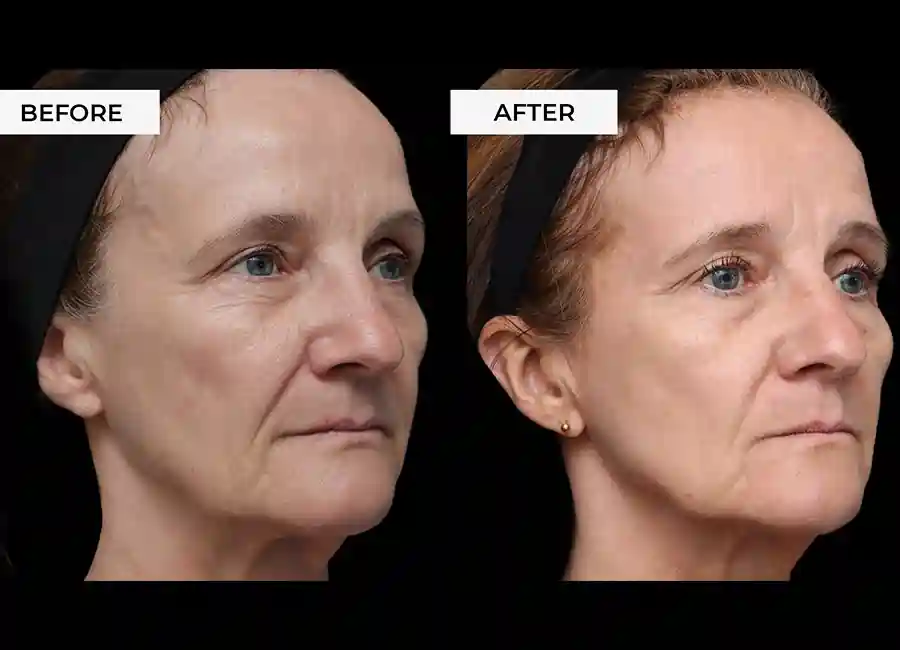 How Many RF Microneedling Sessions Will You Need to See a Difference Billingshurst?