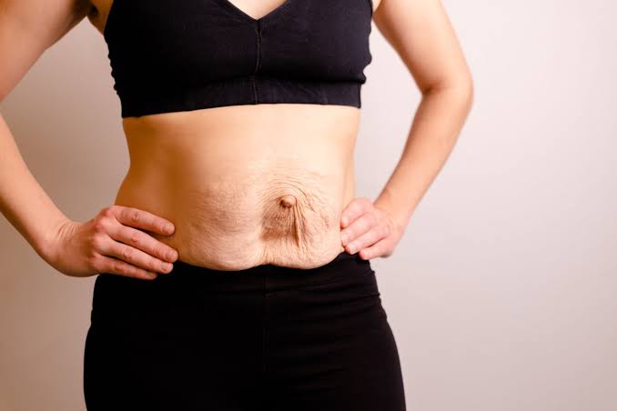 Is Surgery Really the Only Way to Repair Diastasis Recti Billingshurst?
