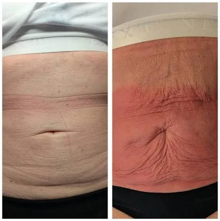 How Does RF Microneedling Improve Crepey, Thin and Uneven Skin Texture Billingshurst?