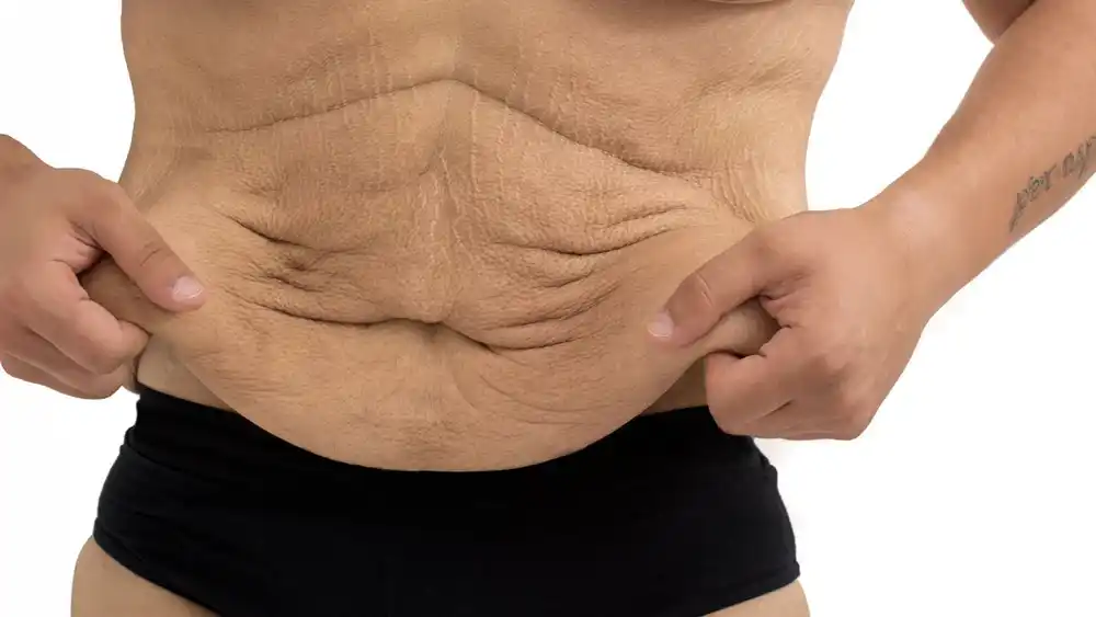 Why Does Weight Loss Medication Leave Some People With Loose or Sagging Skin Billingshurst?